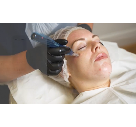 Microneedling